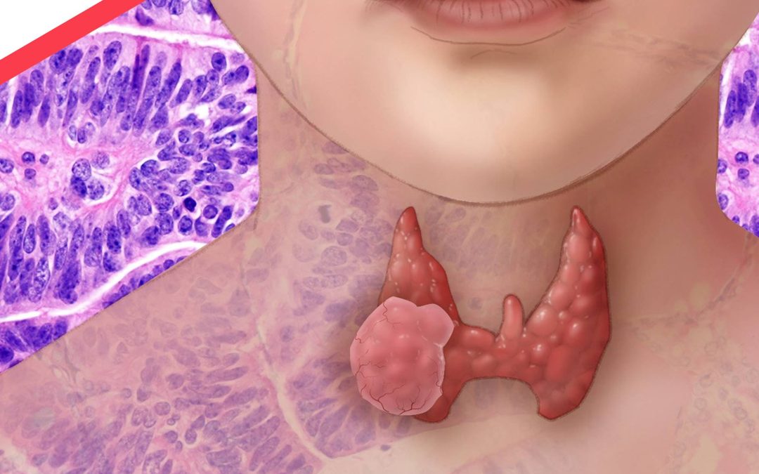 Факторы риска развития рака щитовидной железы