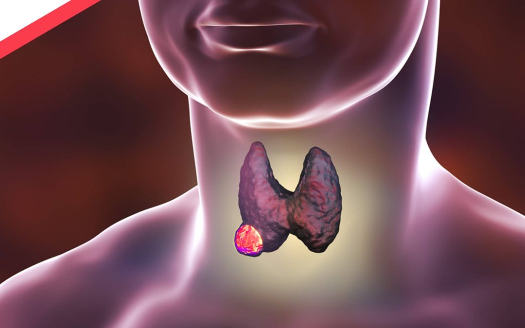 Рак щитовидной железы и его симптомы